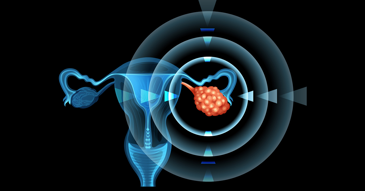 Câncer de ovário: sintomas, exames e se tem cura - Minha Vida