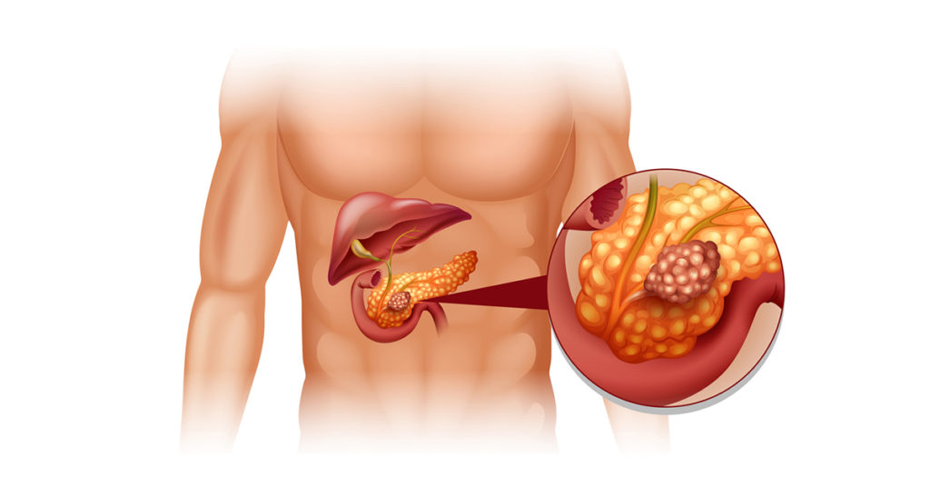 Câncer de pâncreas sintomas: quais são os primeiros sinais e quando procurar ajuda 1 Imagem atual: Câncer de pâncreas: Conheça os sintomas e tratamentos