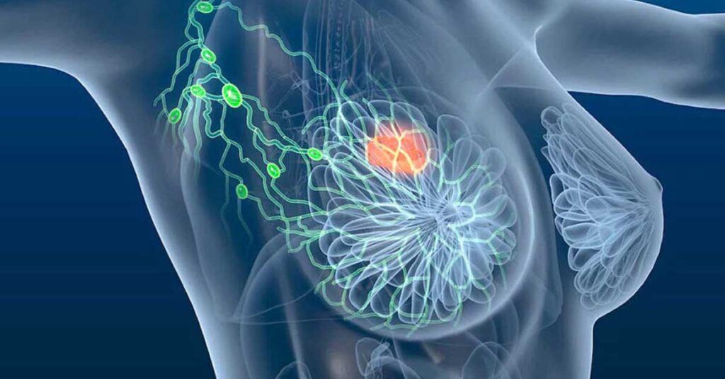 Câncer de mama estágio 3: Sintomas, tratamento e prognóstico 1 Câncer de mama estágio 3: Sintomas, tratamento e prognóstico
