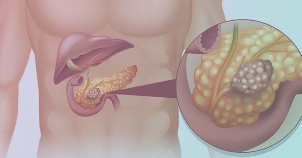 Câncer no pâncreas: Sintomas, tratamento e possibilidade de cura