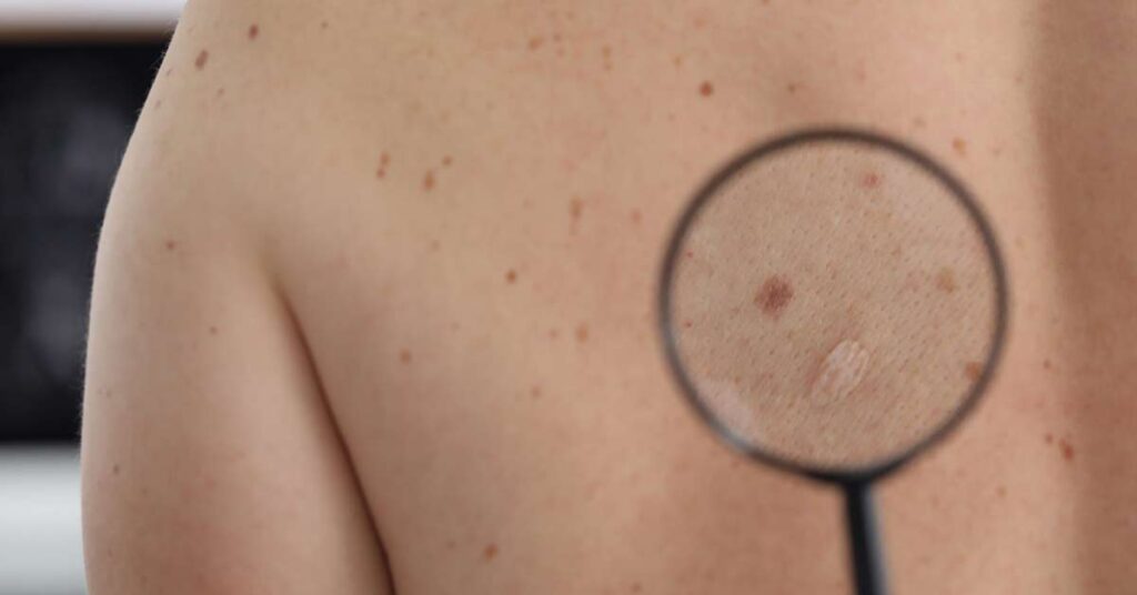 Imunoterapia Combinada: Potencializando os Tratamentos para Melanoma 1 Imunoterapia Combinada_ Potencializando os Tratamentos para Melanoma Avançado