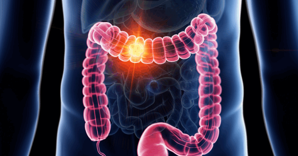 Câncer no Intestino: Sintomas, Diagnóstico e Tratamento Completo 1 1.1 Cancer no Intestino Sintomas Diagnostico e Tratamento Completo